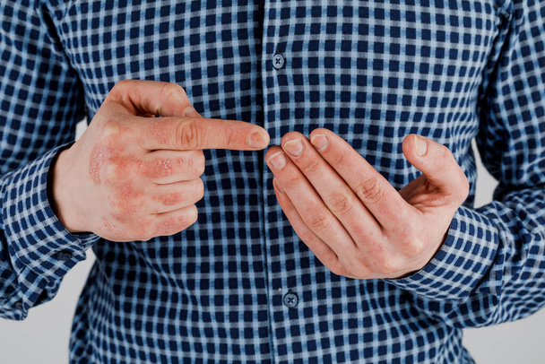 Man met zieke handen, droge schilferige huid op zijn hand met vulgaire psoriasis, eczeem en andere huidziekten zoals schimmel, plaque, uitslag en vlekken. Auto-immuunziekte. - Foto, afbeelding