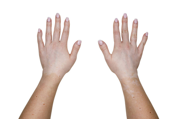 Genç beyaz bir kadının elinin dış kısımlarında vitiligo hastalığından lekeler var. Kırpma yolu olan beyaz bir arka planda izole edilmiş.. - Fotoğraf, Görsel