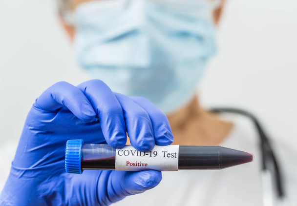 Εξέταση αίματος για τον ιό του κερατοειδούς. Θετικό δείγμα αίματος για το 2019-ncov. - Φωτογραφία, εικόνα