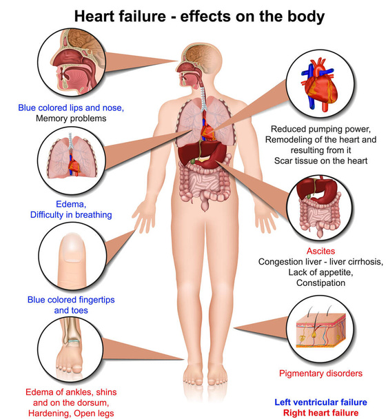 Hearth failure effects of the body 3d medical vector illustration on white background, infographic - Vector, Image