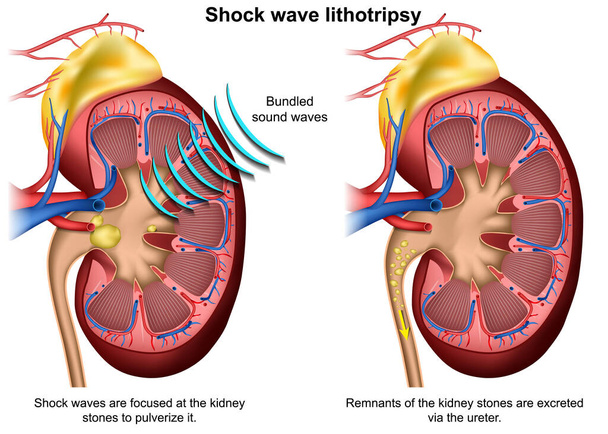 Shock wave lithotripsy 3d medische vector illustratie op witte achtergrond - Vector, afbeelding