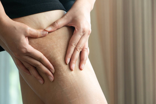 Mão feminina detém celulite gorda e estrias na perna em casa, conceito de estilo de dieta feminina
 - Foto, Imagem