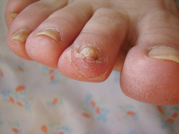 Nagelpilz auf den Zehen Art von infizierten Nägeln Nahaufnahme - Foto, Bild