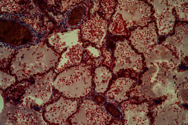 顕微鏡下で肺結核組織200x - 写真・画像
