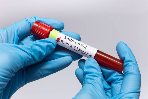 Blood positive test to coronavirus. Medical reseach, test-tube with blood, hand in latex medical gloves. Coronavirus outbreak and influenza. 2019-nCoV, covid-19, sars. High quality photo.  - Foto, Bild
