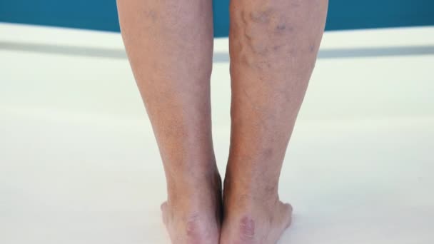 Onderzoek van spataderen bij een oudere vrouw in close-up. Aderen op de benen van een vrouw met spataderen. Spataderen in een oude vrouw in een verwaarloosde toestand - Video