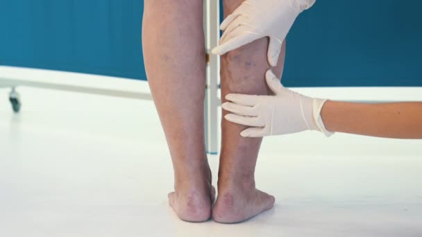 Onderzoek van spataderen bij een oudere vrouw in close-up. Een arts in handschoenen onderzoekt de aderen op de benen van een vrouw met spataderen. Spataderen in een oude vrouw in een verwaarloosde toestand - Video