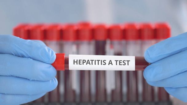 Laboratory assistant wearing protection gloves holds vial with hepatitis A test - Fotó, kép