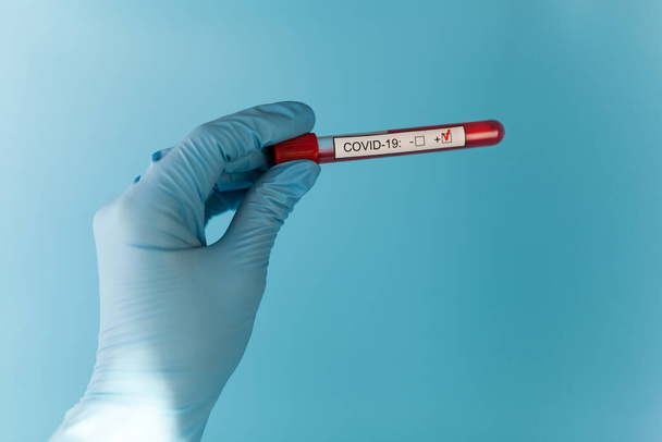 Kilka Rurki wyniki krwi w lekarz ręce mers cov koronawirusa test dodatni etykieta w szpitalu. Nowy szybko rozprzestrzeniający się koronawirus, światowa pandemia. - Zdjęcie, obraz