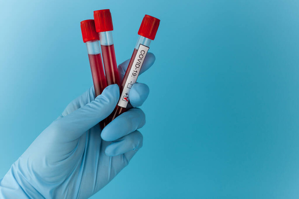 Pocos resultados de sangre tubos en el médico mano mers cov coronavirus prueba de etiqueta positiva en el hospital. Nueva propagación rápida del Coronavirus, pandemia mundial
. - Foto, Imagen