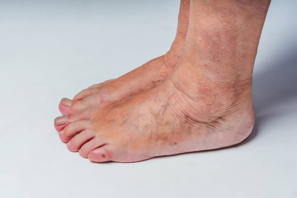 Venas varicosas en los pies de una anciana. Venas dilatadas inflamadas en las piernas. Venas varicosas en la etapa avanzada tardía. Pies de anciana
 - Foto, imagen