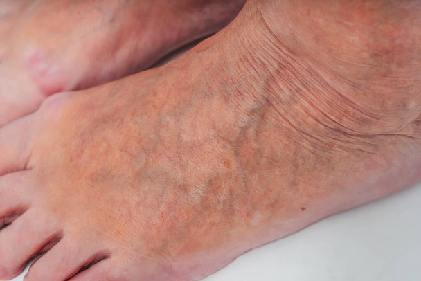 Varicose veins on the feet of an elderly woman. Inflamed dilated veins in the legs. Varicose veins in the late advanced stage. Old woman's feet - Photo, Image