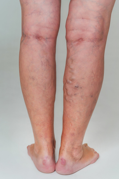 Venas varicosas en una mujer mayor. Venas dilatadas inflamadas en las piernas. Venas varicosas en la etapa avanzada tardía
. - Foto, imagen