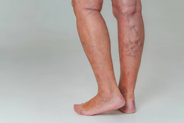 Varicose veins in an elderly woman. Inflamed dilated veins in the legs. Varicose veins in the late advanced stage. - Photo, Image