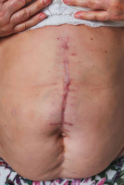 Cicatrice post-operatoria sul corpo di una donna anziana. Cicatrice dopo la rimozione della cistifellea. Le cuciture sull'addome dopo l'intervento chirurgico
 - Foto, immagini