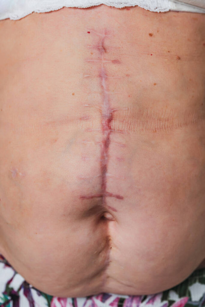 Cicatriz postoperatoria en el cuerpo del torso de una anciana. Cicatriz después de extirpar la vesícula biliar. Las costuras en el abdomen después de la cirugía
 - Foto, Imagen