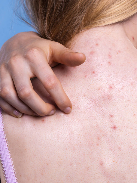 Health problem, skin diseases. Young woman showing her back with acne, red spots. Teen girl scratching her shoulder with pimples. - Zdjęcie, obraz