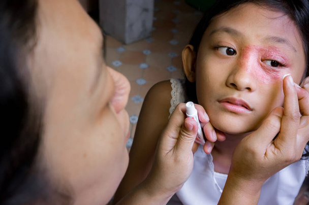 Zuidoost-Aziatische etniciteit tienermeisje met ronde vorm huiduitslag op haar gezicht rond het oog en de neus, wordt toegepast Anti schimmelcrème voor medicatie door haar moeder. Tinea corporis dermatitis huidprobleem - Foto, afbeelding