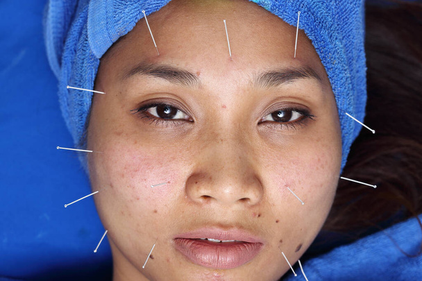 Close up Hand Perform Medical der professionellen Akupunktur-Behandlung in Beauty Spa auf Gesicht, Wange, Stirn, Kinn, Lippe von Expertin Kosmetikerin aus dem chinesischen Nadelinstitut, Konzept Anti-Aging - Foto, Bild