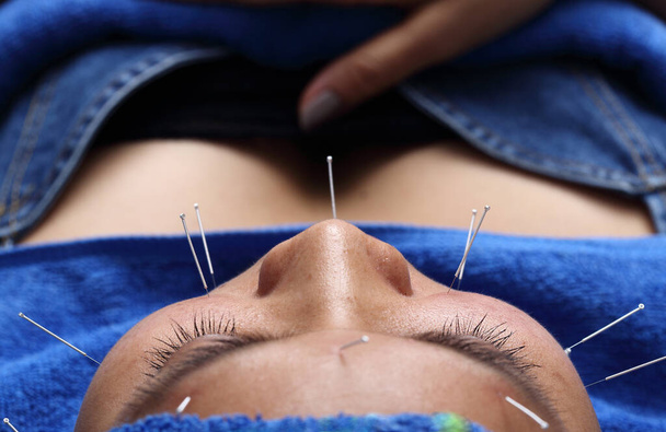 Close up Hand Perform Medical der professionellen Akupunktur-Behandlung in Beauty Spa auf Gesicht, Wange, Stirn, Kinn, Lippe von Expertin Kosmetikerin aus dem chinesischen Nadelinstitut, Konzept Anti-Aging - Foto, Bild