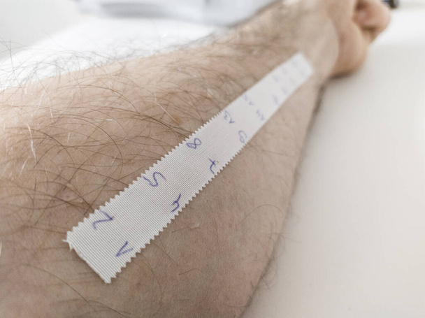Teste de picada de pele alérgica em laboratório
 - Foto, Imagem