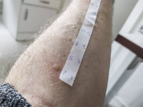 Allergiás bőrszúrásos teszt laboratóriumi körülmények között - Fotó, kép