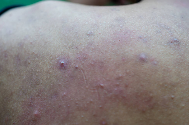 Asiático adolescente menino Inflamatório acne nas costas
 - Foto, Imagem