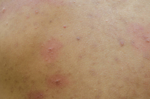 Asiatique adolescent garçon Inflammatoire acné sur le dos
 - Photo, image