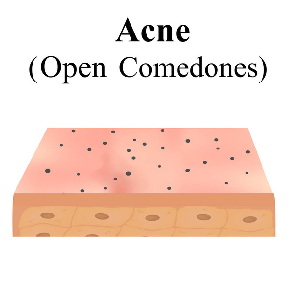 Open comedones. Acne on the skin. Dermatological and cosmetic diseases on the skin of the face acne. Infographics. Vector illustration on isolated background. - Vector, Image