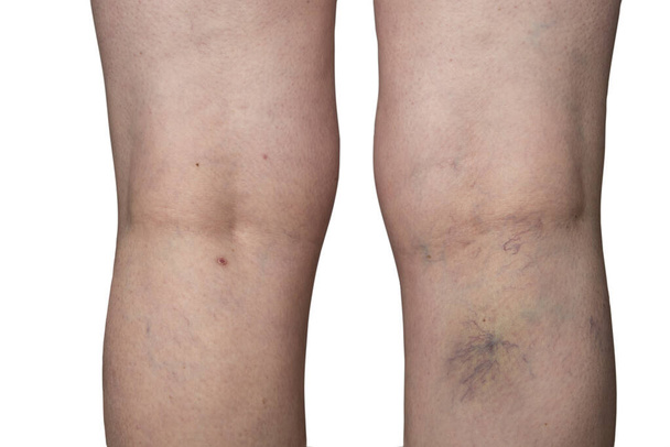 Bursted capillaries on a woman leg - Photo, Image