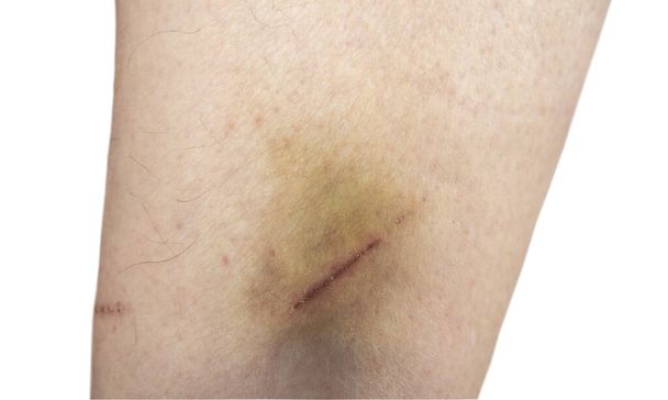 Η μελανιά σε αντρικό πόδι. Έννοια τραυματισμού - Φωτογραφία, εικόνα
