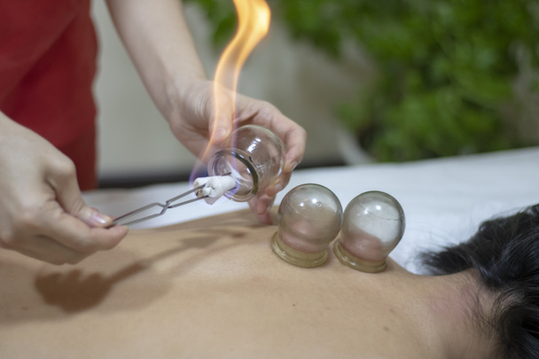 Terapeuta de acupuntura instalando um copo de fogo nas costas de uma jovem mulher
 - Foto, Imagem