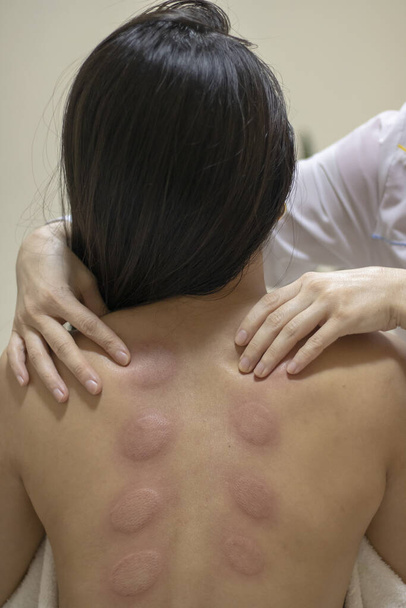 Massagem de pescoço para mulher jovem no salão de beleza, vestígios de massagem a vácuo
 - Foto, Imagem