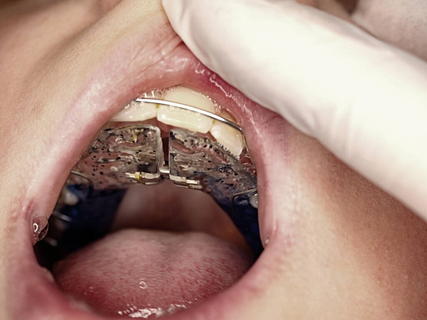 Ortodonta wkładający podwiązki do ust dzieci, urządzenie ortodontyczne. Chłopiec trzyma otwarte usta - Zdjęcie, obraz