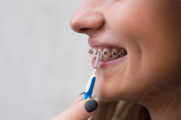 Beautiful young girl with metal braces for teeth with white teeth and brush - Photo, image
