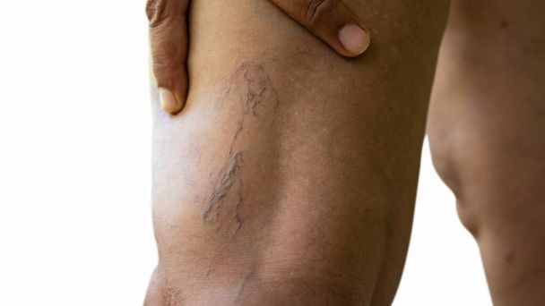 Veias varicosas em mulheres jovens pernas
 - Foto, Imagem