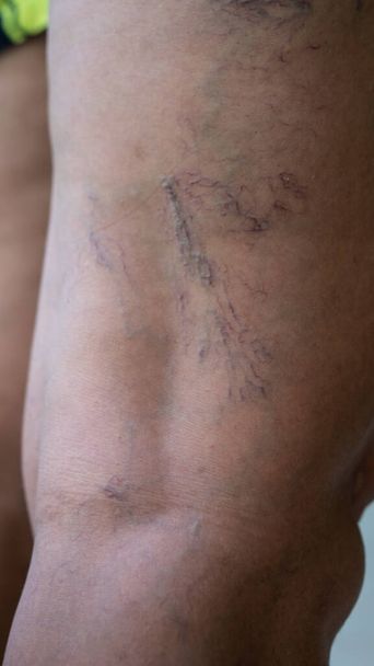 Venas varicosas en las piernas de las mujeres jóvenes
 - Foto, imagen