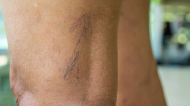 Venas varicosas en las piernas de las mujeres jóvenes
 - Foto, imagen