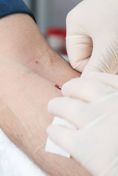 inserts a needle into a vein, close-up, preparation for taking blood test from a vein, mobile blood station. Donation blood to support during a pandemia of coronavirus, World blood donor day - Foto, imagen