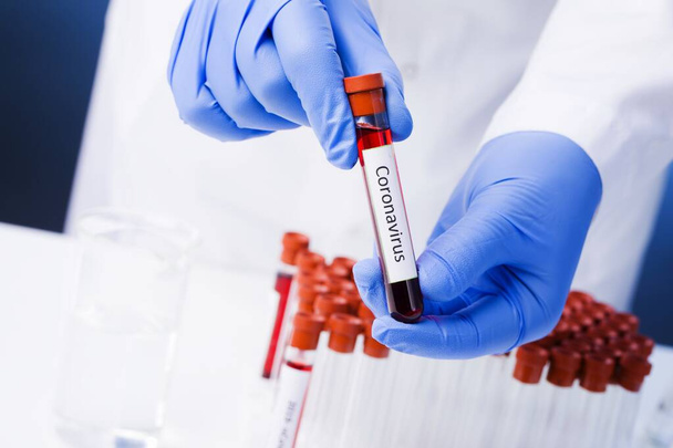 Positive blood test result for the new rapidly spreading Coronavirus, Coronavirus 2019-nCoV Blood Sample. Corona virus outbreaking. Epidemic virus Respiratory Syndrome. - Фото, изображение