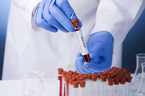 Positive blood test result for the new rapidly spreading Coronavirus, Coronavirus 2019-nCoV Blood Sample. Corona virus outbreaking. Epidemic virus Respiratory Syndrome. - Фото, изображение