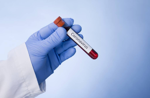 Coronavirus 2019-nCoV Blood Sample. Corona virus outbreaking. Epidemic virus Respiratory Syndrome. - Valokuva, kuva