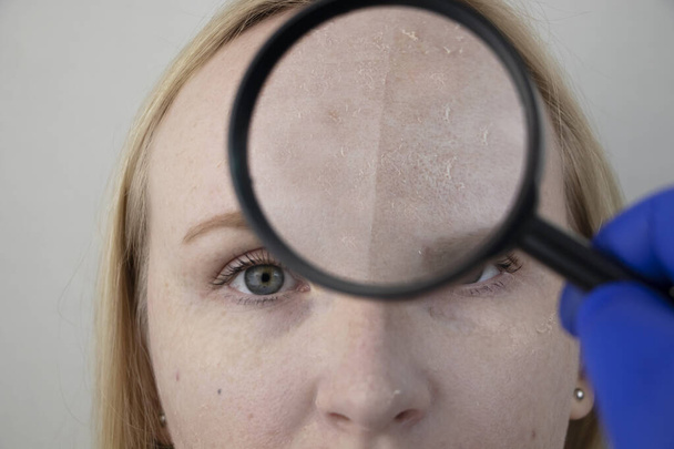 Una mujer examina la piel seca de su cara. Peeling, grosor, molestias, sensibilidad de la piel. Paciente en la cita de un dermatólogo o cosmetólogo, selección de crema para la sequedad
 - Foto, imagen