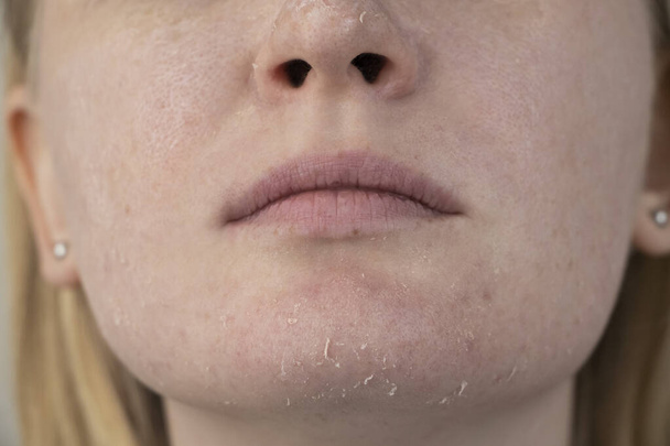 Une femme examine la peau sèche sur son visage. Peeling, enrobage, gêne, sensibilité cutanée. Patient à la nomination d'un dermatologue ou d'un cosmétologue, sélection de la crème pour la sécheresse
 - Photo, image