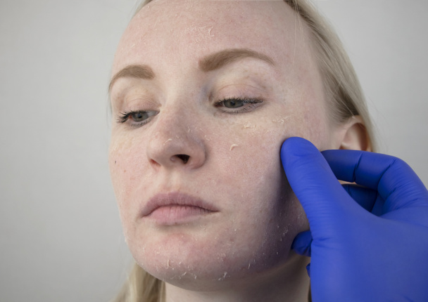 Una mujer examina la piel seca de su cara. Peeling, grosor, molestias, sensibilidad de la piel. Paciente en la cita de un dermatólogo o cosmetólogo, selección de crema para la sequedad
 - Foto, Imagen