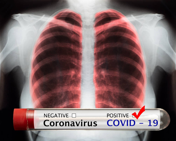 Tıbbi teşhis için Coronavirus testi ve insan göğsünün röntgen görüntüsü. - Fotoğraf, Görsel