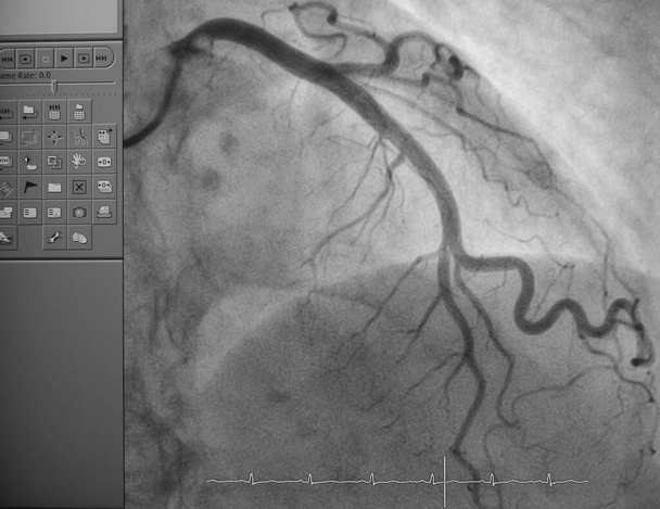 Coronaire angiografie, linker coronaire angiografie - Foto, afbeelding