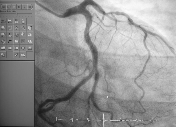 Angiografía coronaria, angiografía coronaria izquierda
 - Foto, imagen