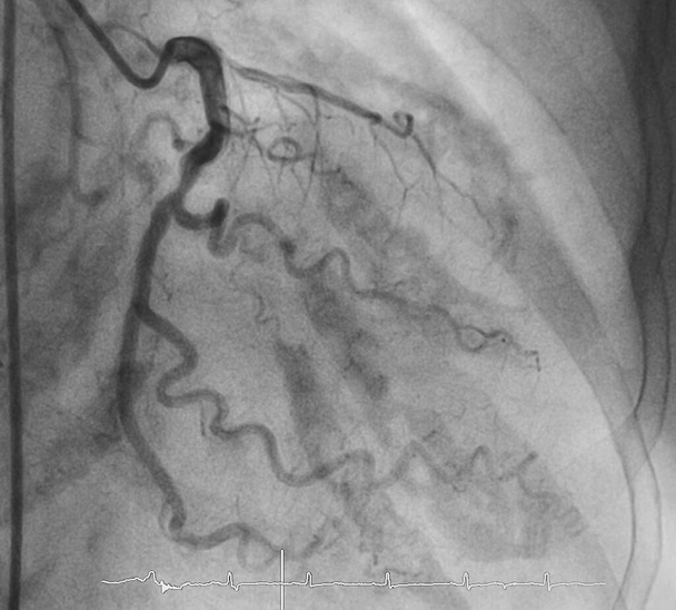 Coronary angiography , left coronary angiography - Photo, Image