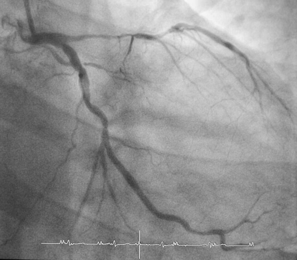 Coronaria angiográfia, bal coronaria angiográfia - Fotó, kép